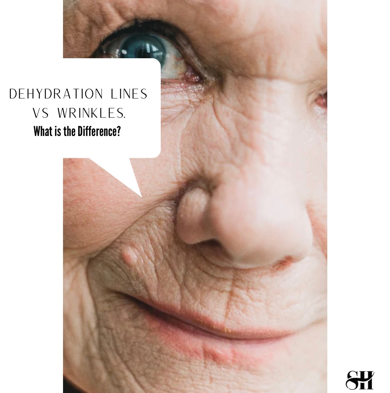 Dehydration Lines Vs. Wrinkles – What is the Difference?