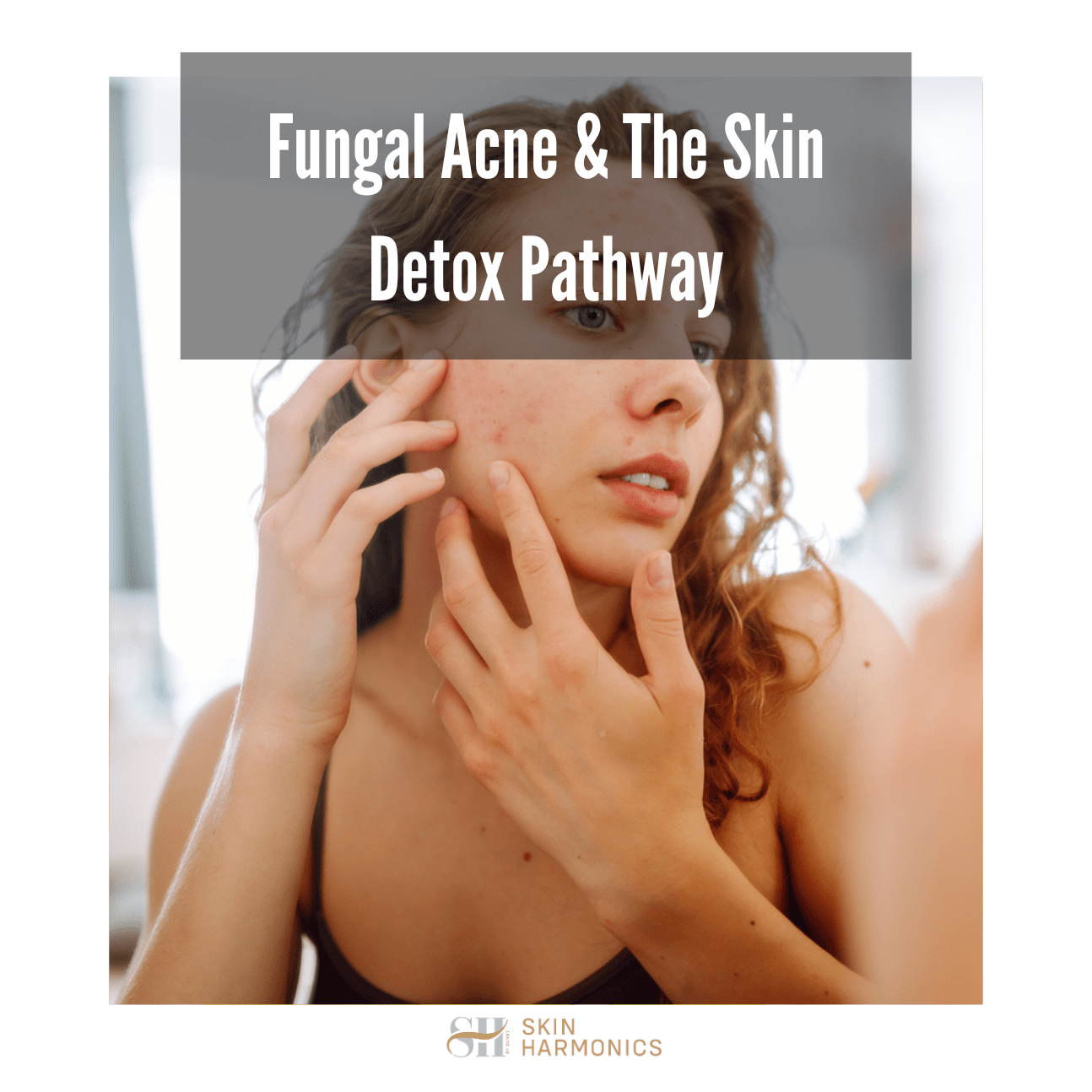 Fungal Acne & The Skin Detox Pathway