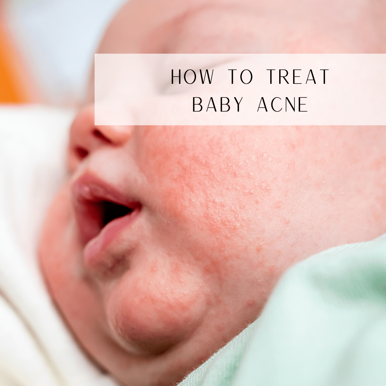How To Treat Baby Acne