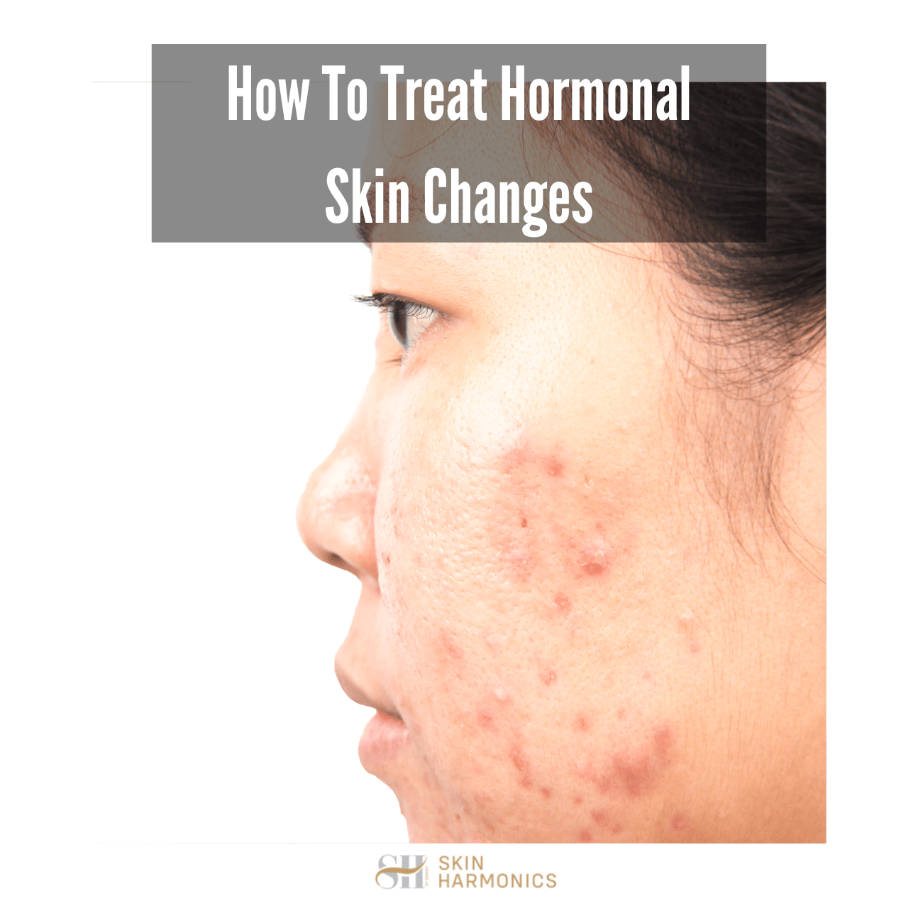 How To Treat Hormonal Skin Changes