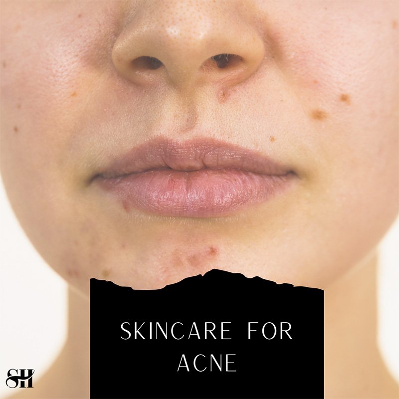 Skin Care for Acne