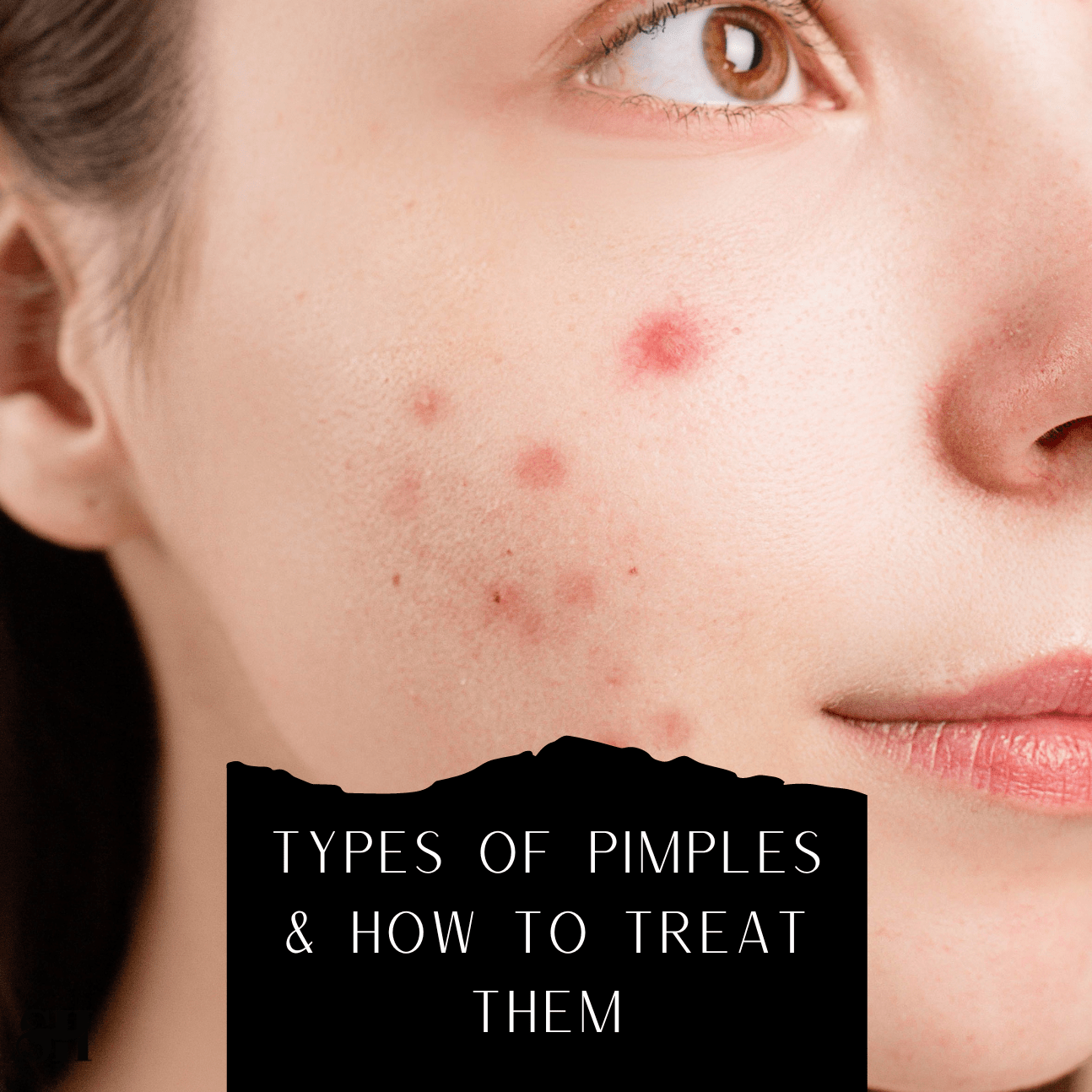 Types Of Pimples & How To Treat Them
