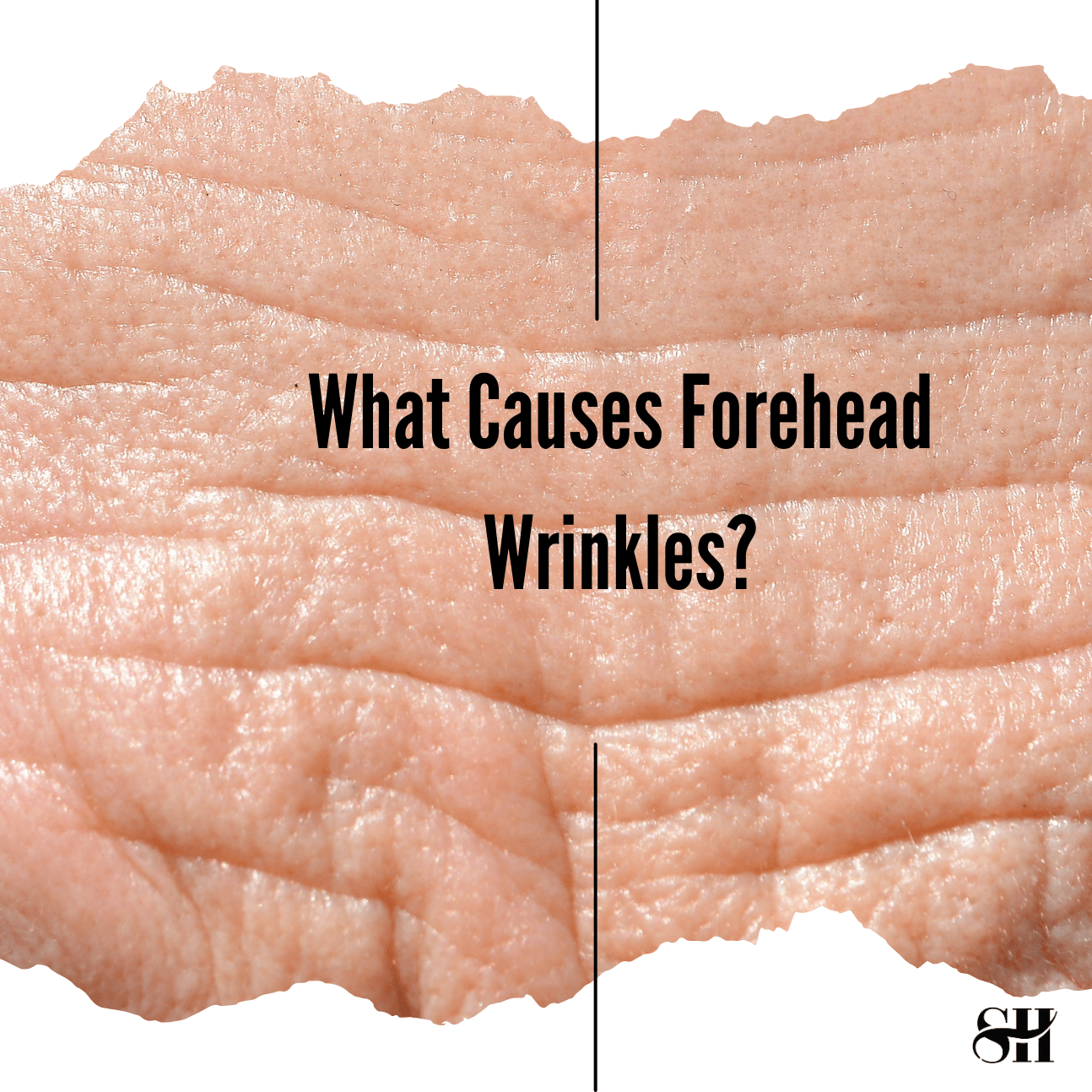 What Causes Forehead Wrinkles?
