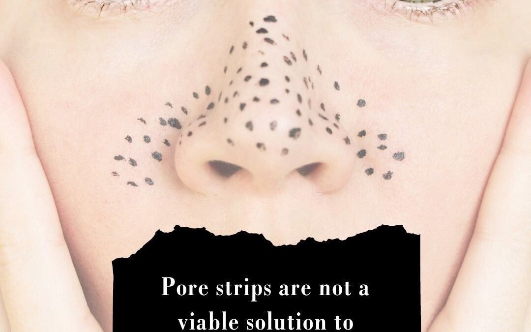 pore strips are not a viable solutions to permanently clearing blackheads