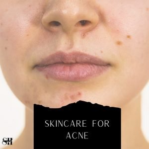 Skincare for Acne