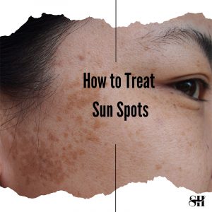 How to Treat Sunspots