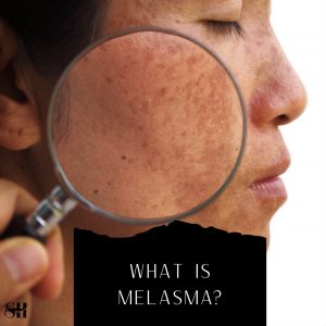 What is Melasma (and How to Treat it)?