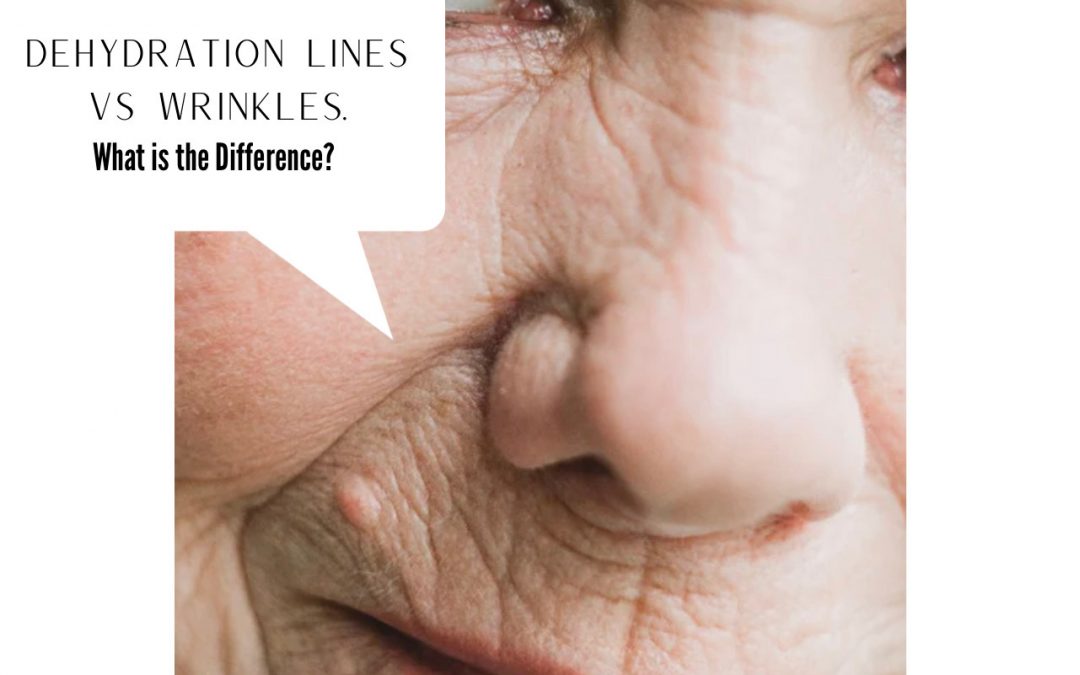 Dehydration Lines Vs. Wrinkles – What is the Difference?