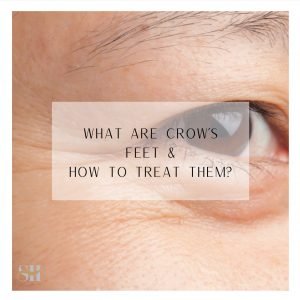 What Are Crow’s Feet and How to Treat Them?