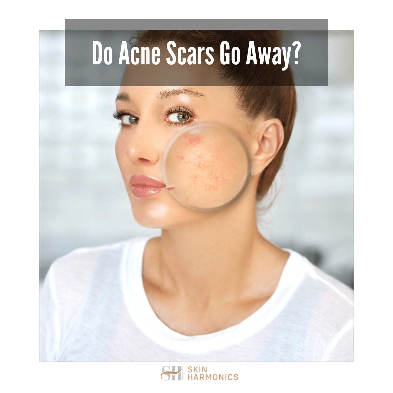 Do Acne Scars Go Away? Skin Harmonics